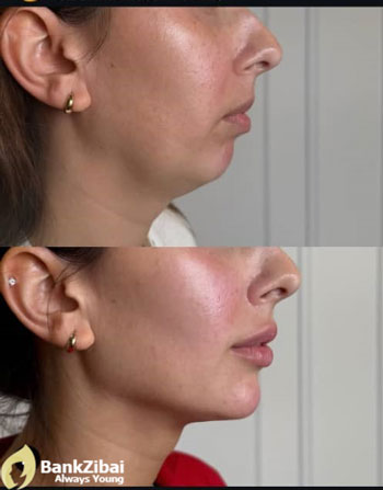 before & after